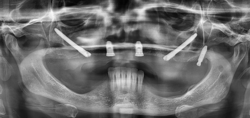 Implante Dentário Zigomático 